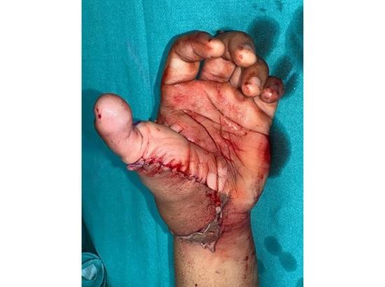 Doctors reconstruct thumb from 20-year-old man's amputated leg